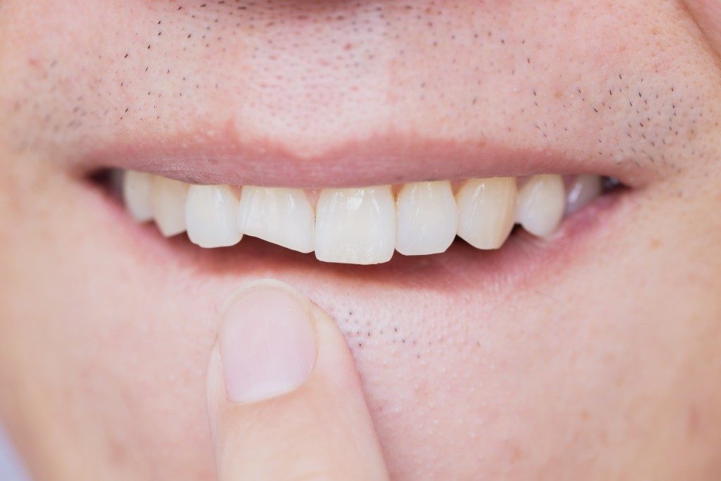 Close up of chipped tooth